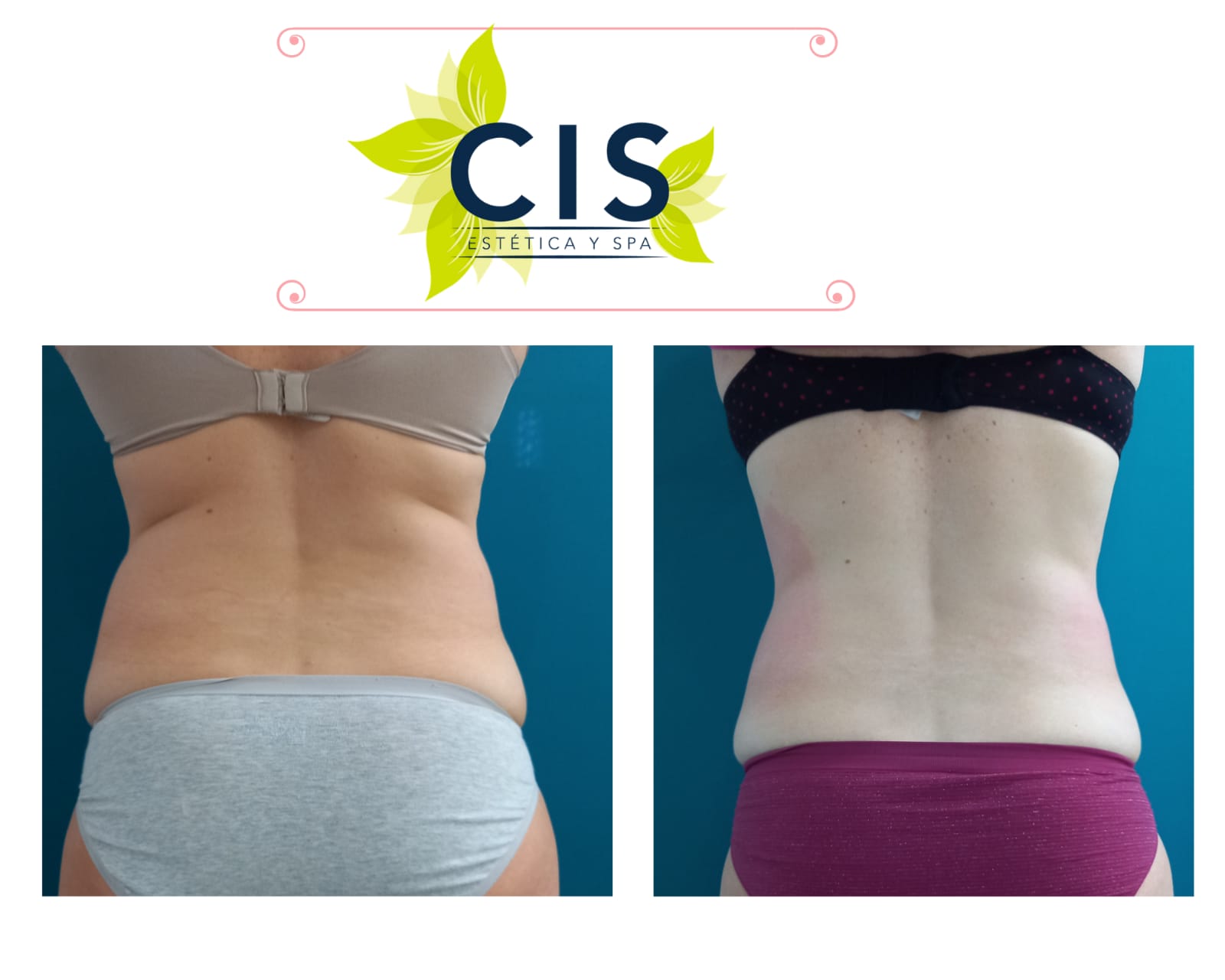 Resultado de moldeo corporal — antes y después