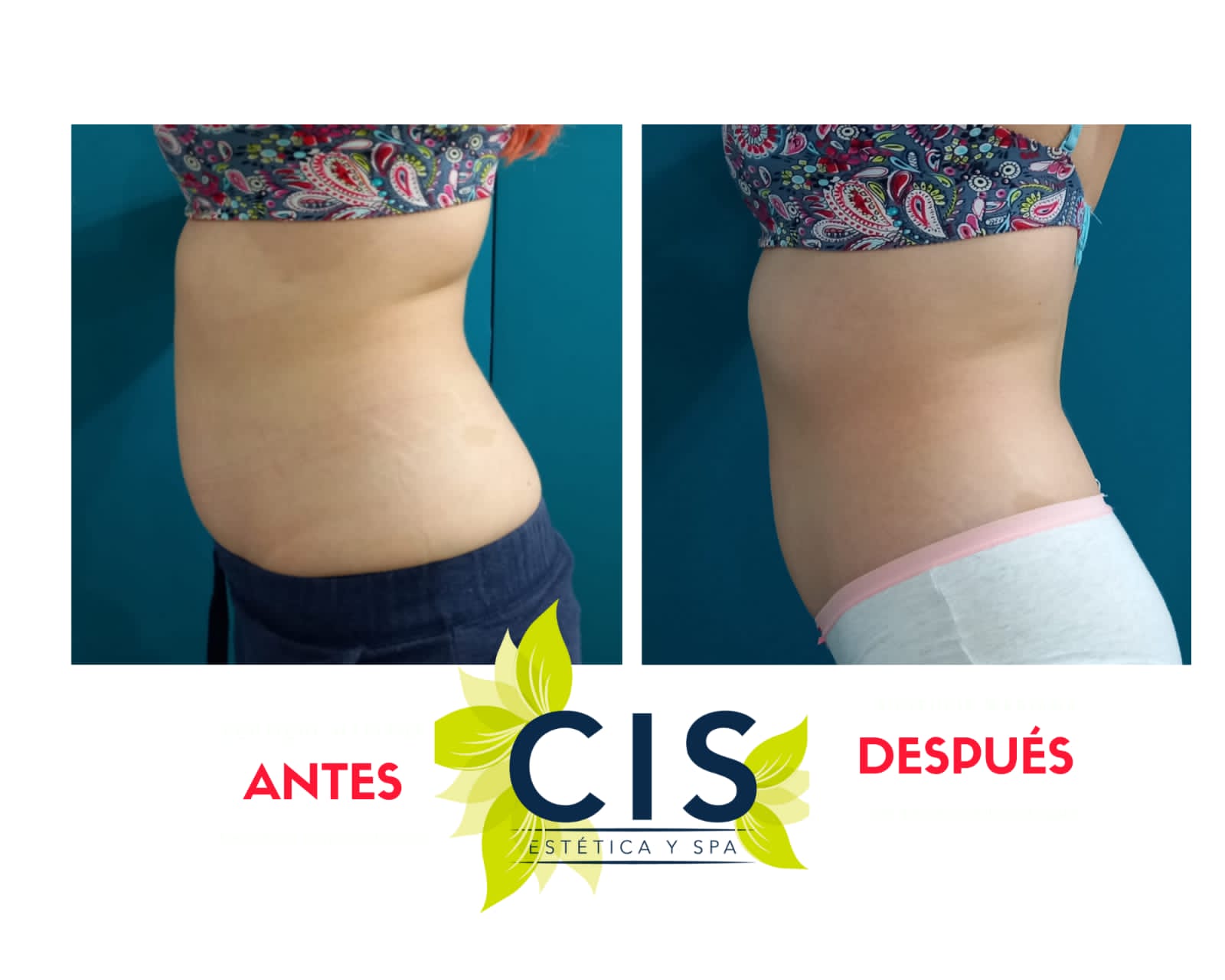 Resultado de tratamiento anticelulítico — antes y después